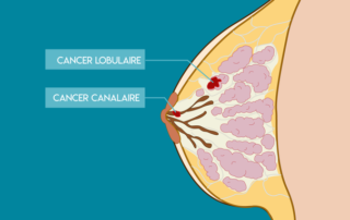 Cancer du sein