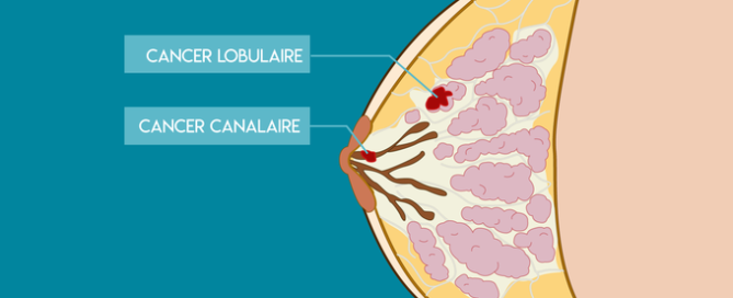 Cancer du sein
