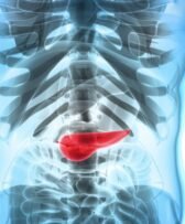 Cancer du pancréas: Une Nouvelle nanomédecine